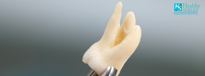 Tooth Extraction in Gardena Tooth Extraction in Gardena